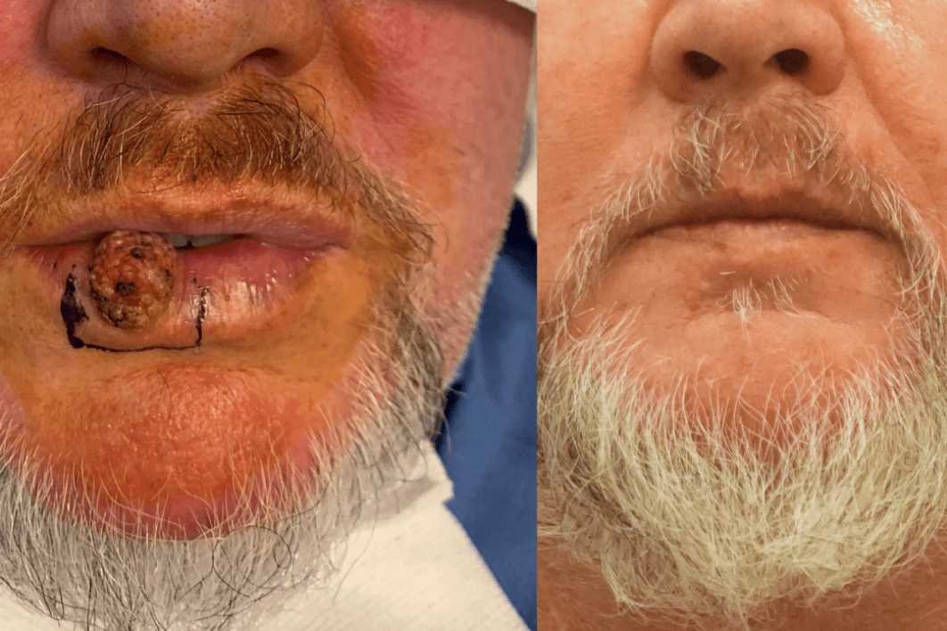 Skin cancer reconstruction