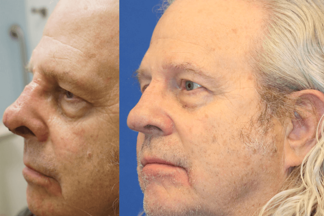 Revision rhinoplasty