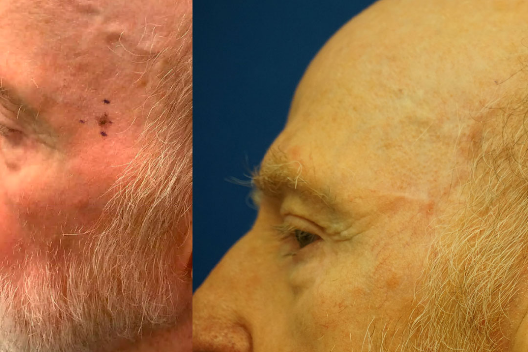 Skin cancer reconstruction