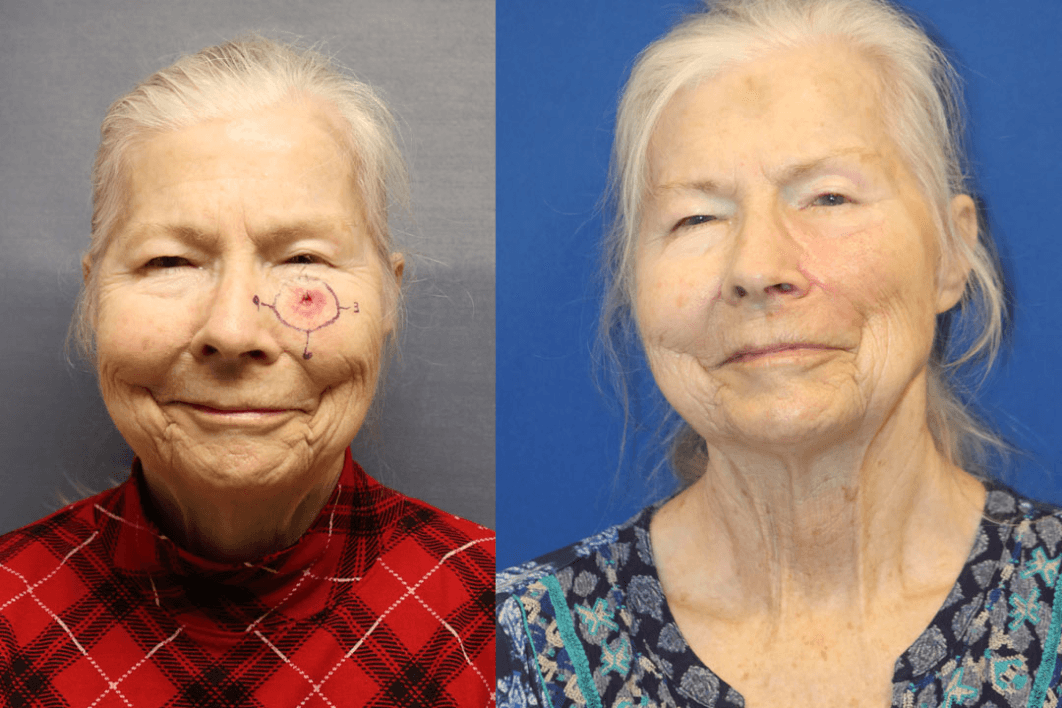 Skin cancer reconstruction